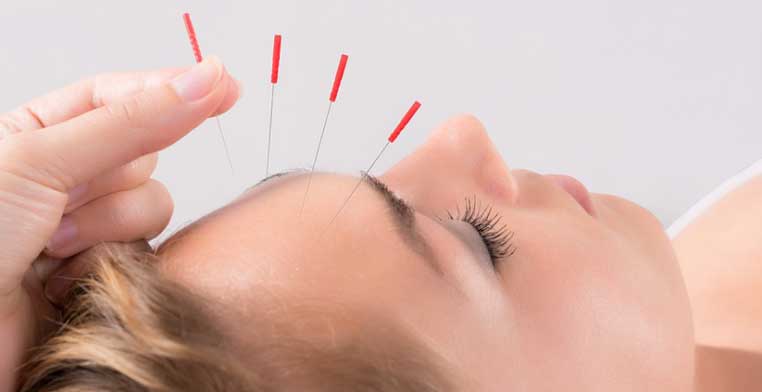 Cara menghilangkan jerawat dengan akupuntur